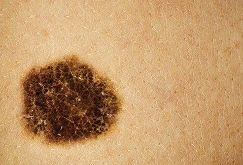 Seborrheic Keratosis: What Is It, Causes, Risks and Treatment
